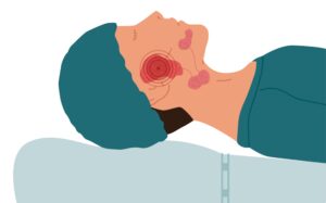 This image shows a patient having an operation to remove sialolithiasis from parotid gland. The purpose of this image is to demonstrate that a possible cause for lymphedema is a damaged parotid gland.